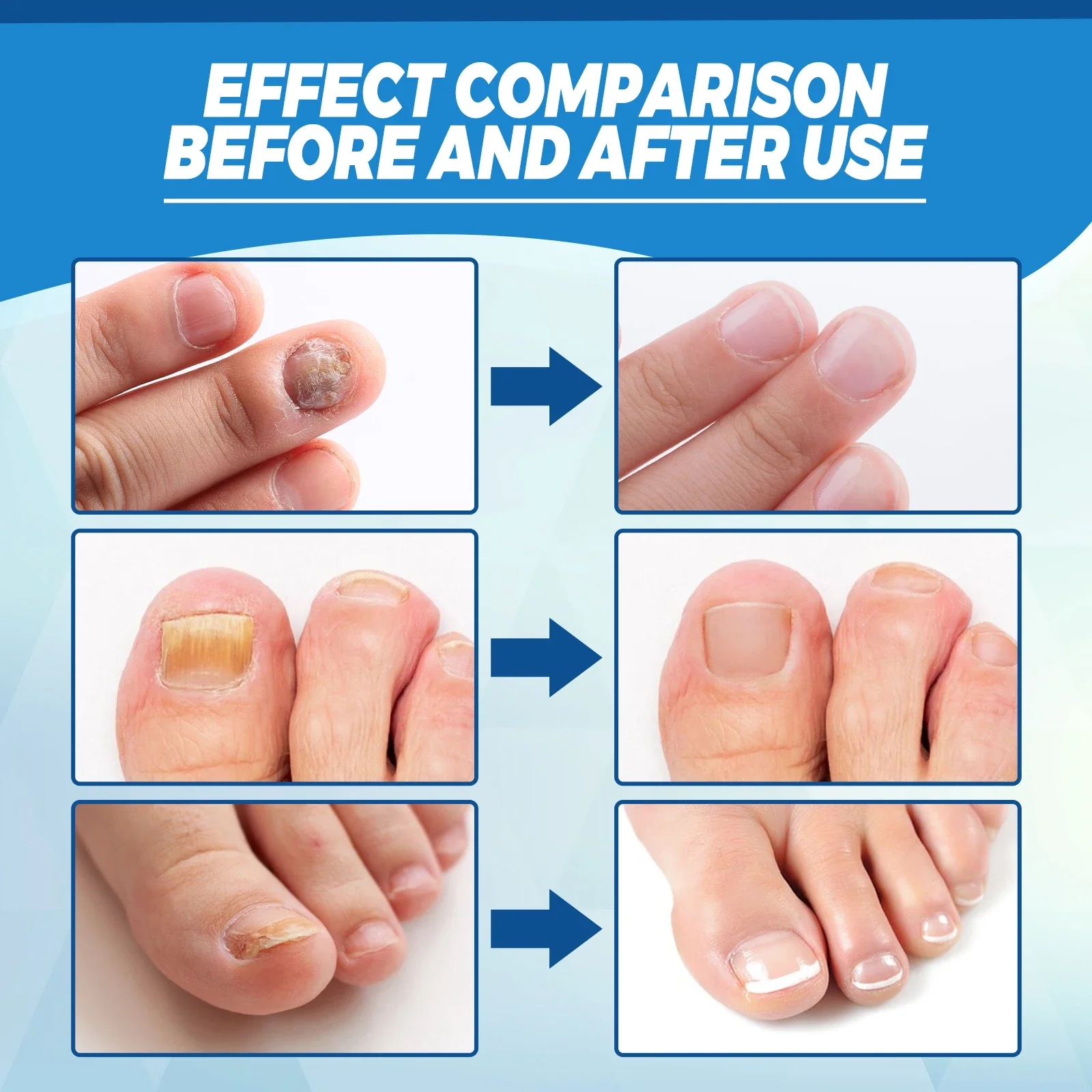 Nail fungus remover Fungal Nail Laser Device Repair Fast Nails Fungus Onychomycosis