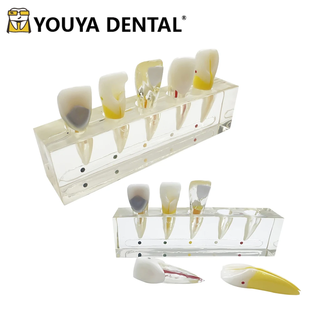 

Dental Teaching Model Dental Pulp Disease Clinical Model For Dentist Technician Studying Doctor-patient Communication Tools