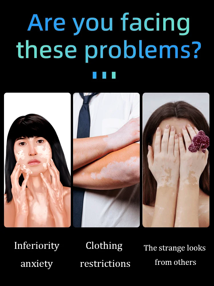 2세대 업그레이드된 백반증 치료제 ? 백반증 치료 ? 빠르게