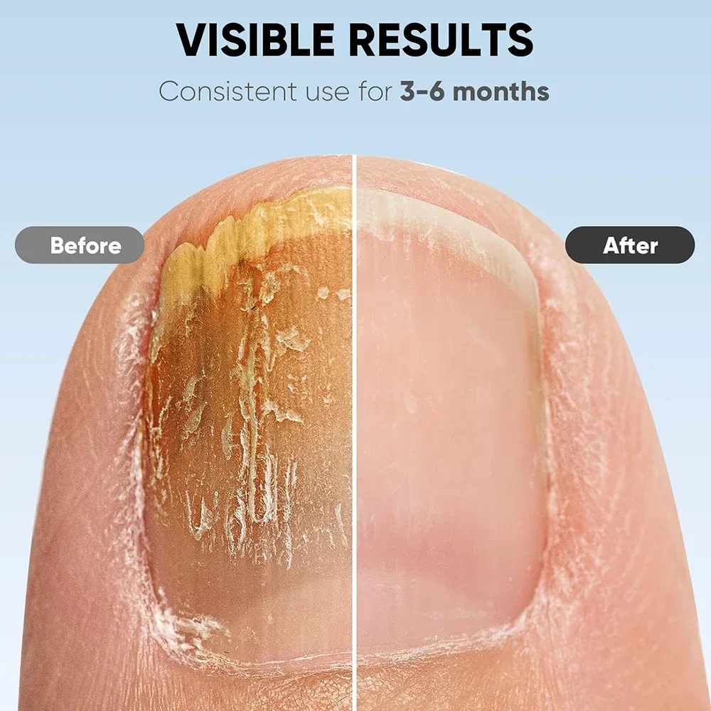Nail fungus treatment LED laser device cleaning onychomycosis USB charge 905nm infrared 470nm blue light nail salon