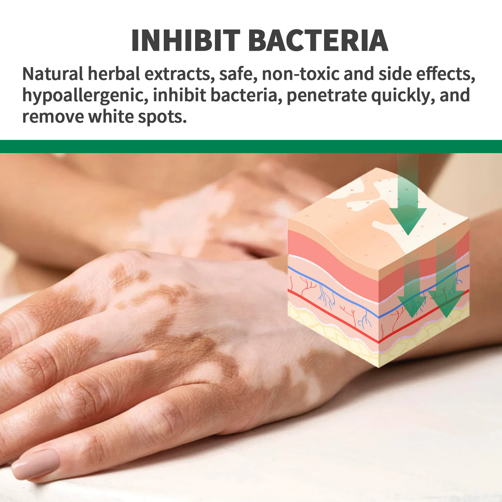 Piebaldism Vs Vitiligo