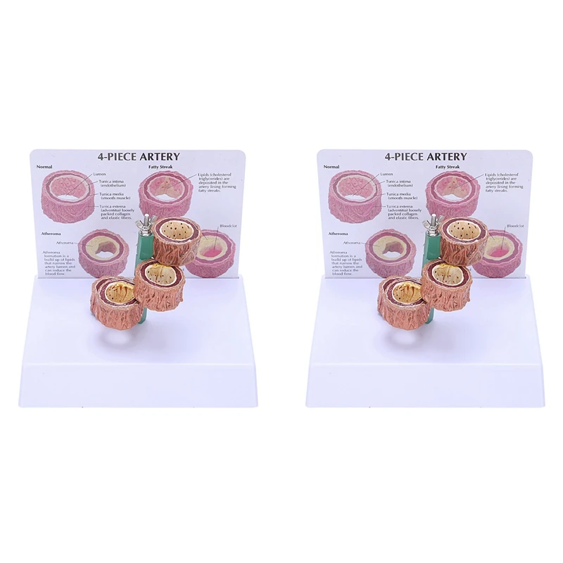 

NEW-2X Atherosclerosis Thrombosis Model Vascular Disease Demonstration Heart Vascular Pathology Model