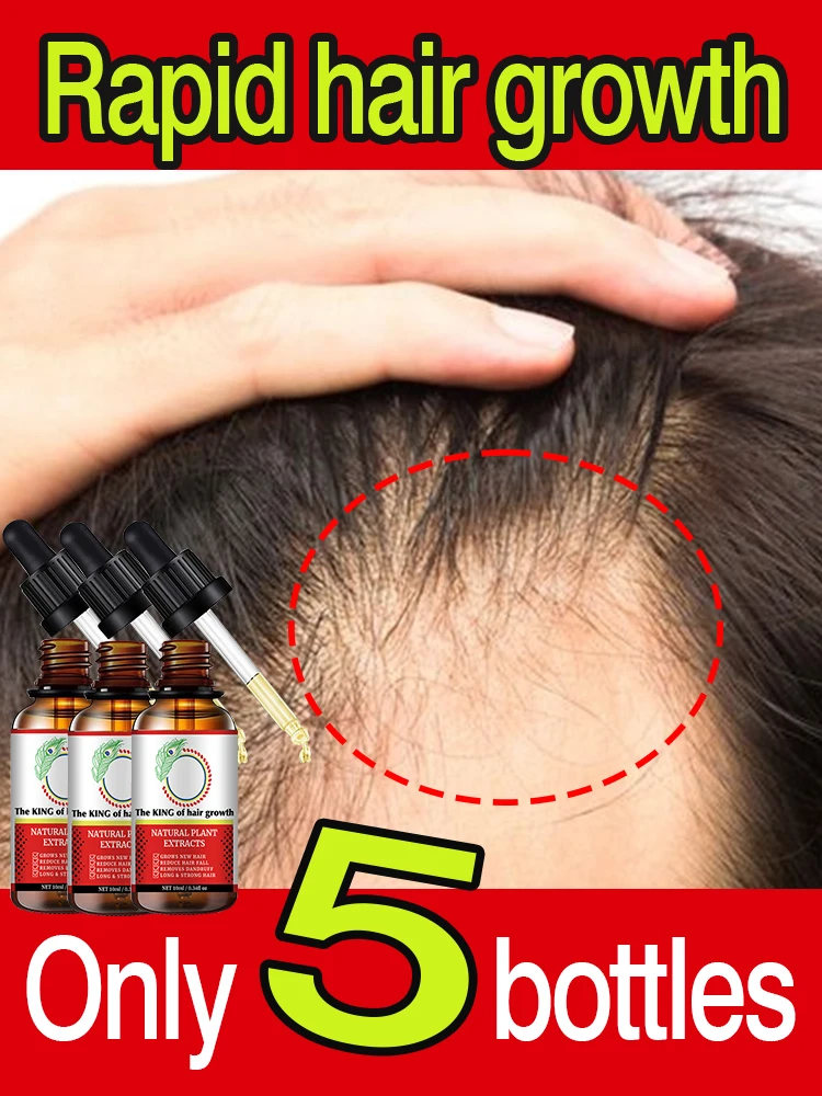

Fast Hair Growth Oil Baldness Repair Hereditary Postpartum Seborrheic Hair Loss