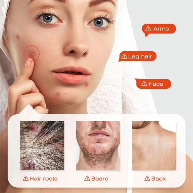 Body Acne Cream – Clear, Smooth & Repair Skin