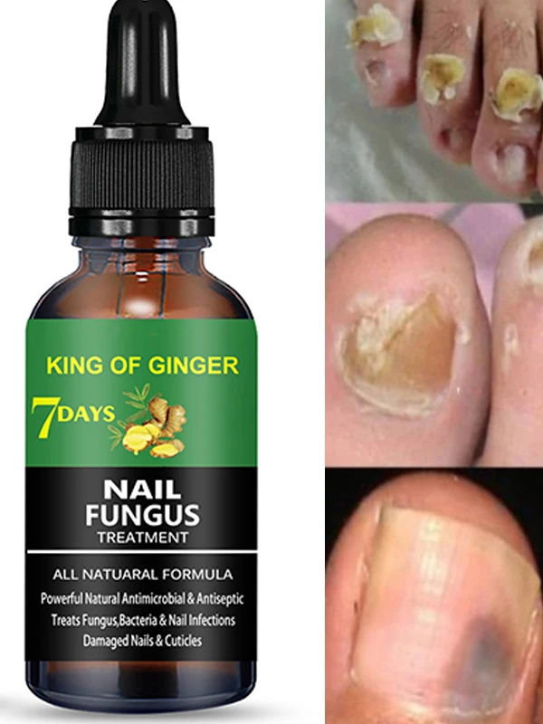 2022 50ml New Nail Fungus Treatment Essence Serum Care Hand Foot Care