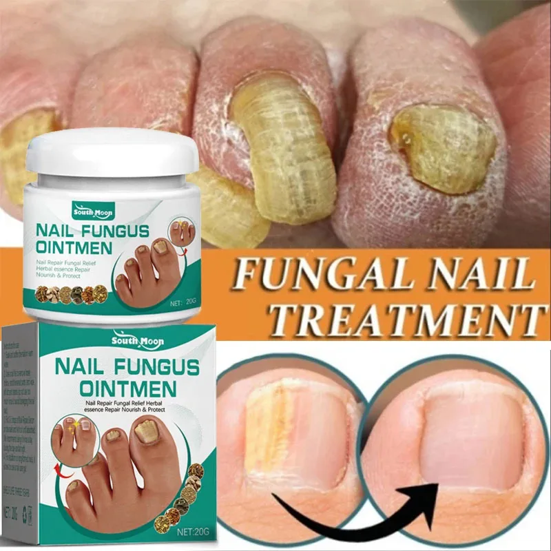 

Nail Fungus Treatment Essence Cream Anti-Infection Anti Fungal Foot Toe Nails Repair Gel Onychomycosis Paronychia Care Products