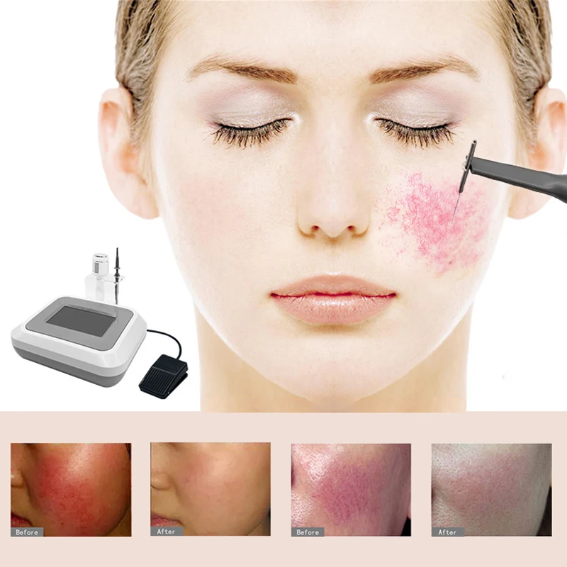2025 NEW Red Blood Vessel Vascular Remover Facial Cleaning Spider Veins Removal High Frequency Needle RF Skincare Beauty Device