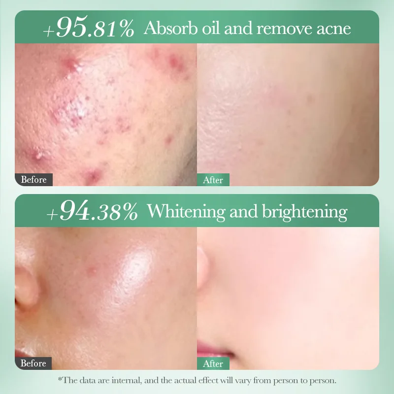 SADOER Salicylic Acid Anti Acne Face Mask Mud Acne Removing Moisturizing Niacinamide Whitening Facial Masks Clay Face Skin Care