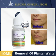 

10ML Skin Tag Remover Genital Wart Treatment Instant Removal Mole&Papillomas Foot Corn Repair Tool Natural Bacteriostatic Liquid