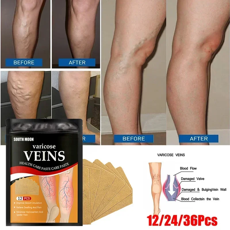 

12pcs Varicose Veins Relief Patch Thigh Leg Pain Removal Phlebitis Plaster Feet Anti Swelling for Foot Health Care