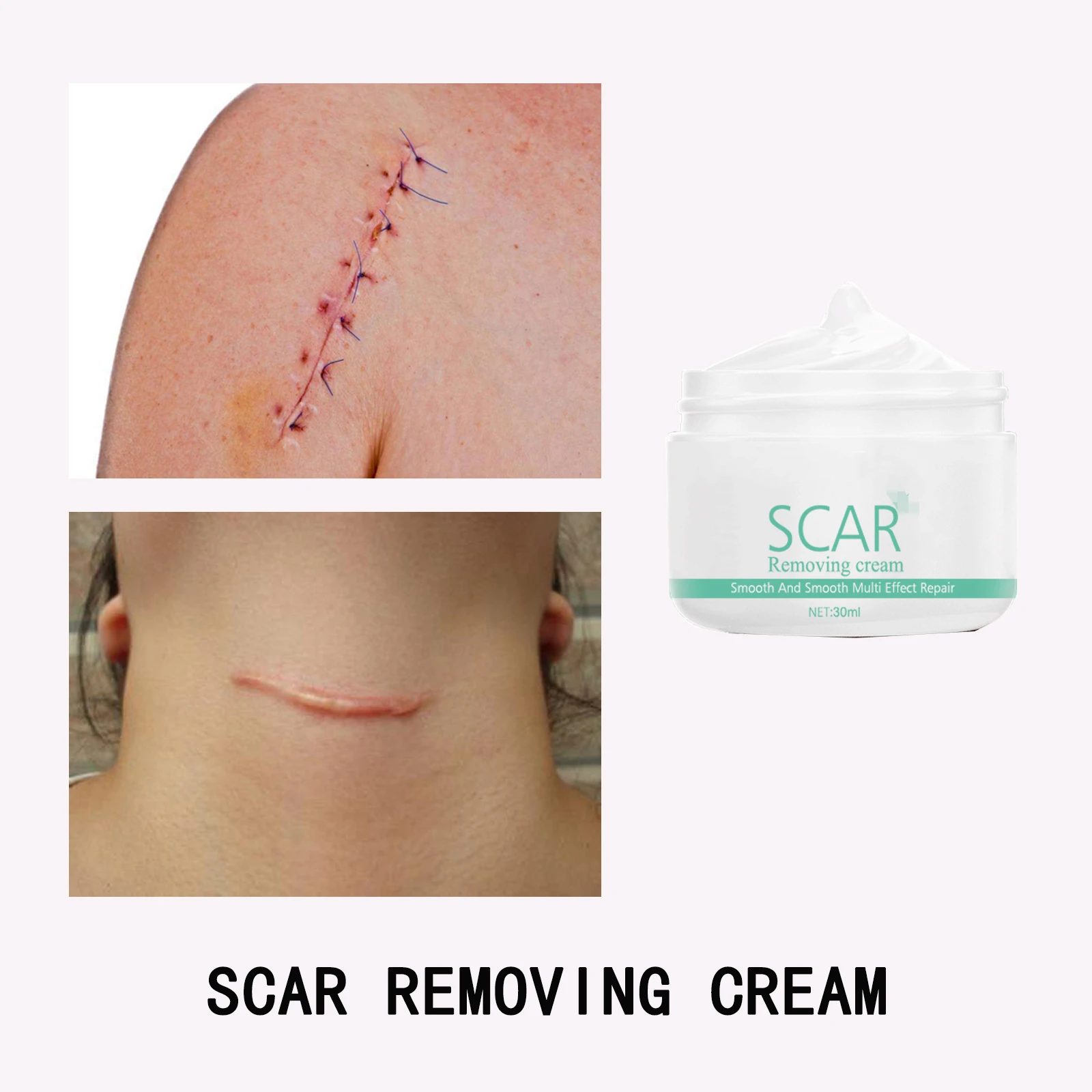 30ML Scar Removal Cream Acne Treatment Marks Pimples Surgical Repair