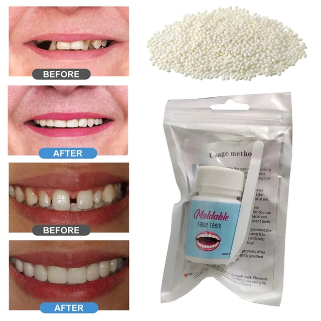 Resin False Teeth That Fit Solid Glue Temporary Tooth Repair Set Moldable  Teeth and Gap False Teeth Glue Denture Tooth Care - AliExpress