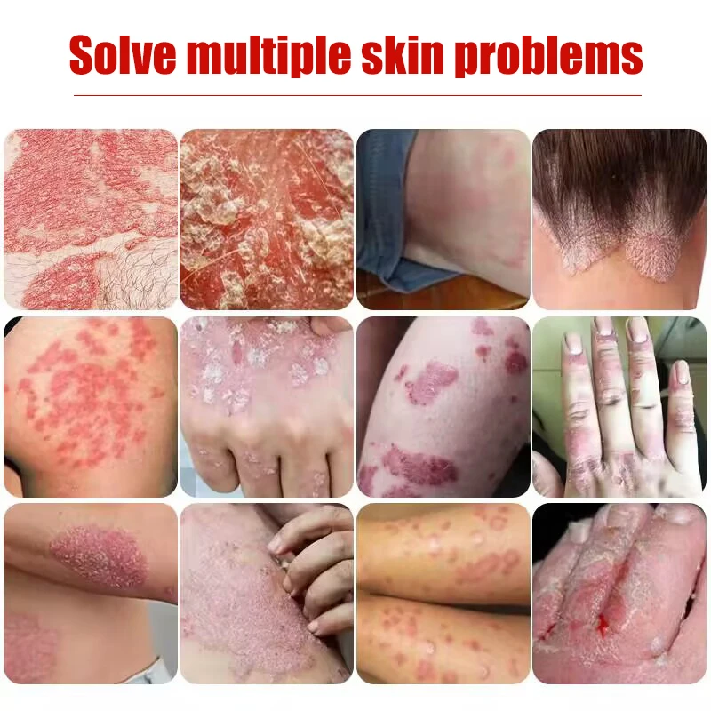 Skin Care Ointment 20g Psoriasis Cream Dermatitis Eczematoid Treatment Antibacterial Anti-Itch