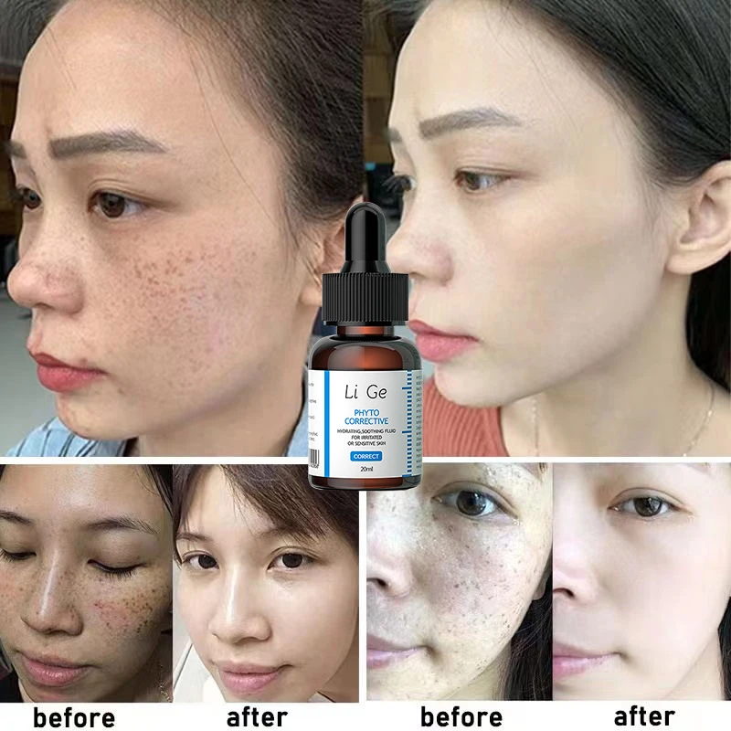 Facial Spot Removal Essence Remove Dark Age Spots Sunspots Melanin Chloasma Pigmentation Lighten Skin Bleaching Whitening Serum