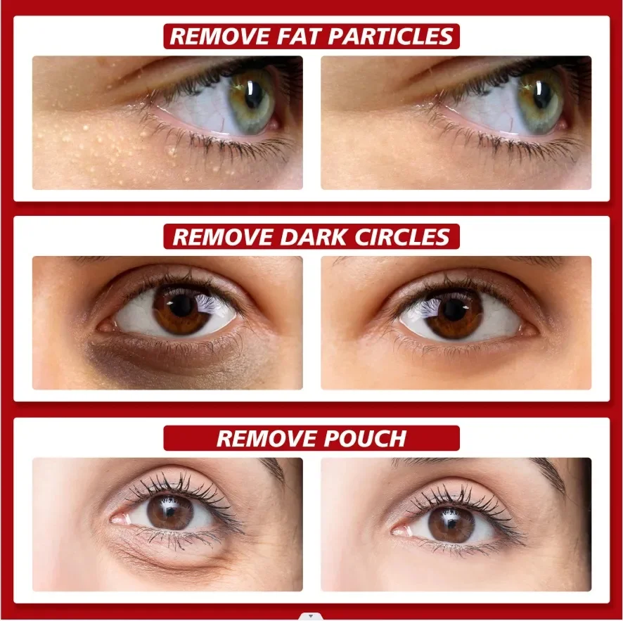 Fat Granules Removal Eye Serum Eye Milia Repair Treatment Products Wrinkle Lifting Moisturizing Anti-Puffiness Korean Skin Care facial serum facial essence retinol face serum salicylic acid facial serum