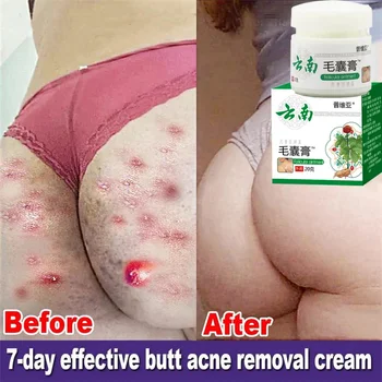 Body Acne Removal Cream – 1