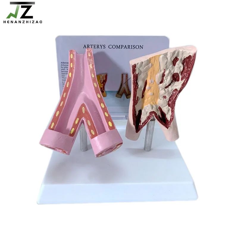 

Comparison Model of Smoking Blood Vessels and Healthy Arterys