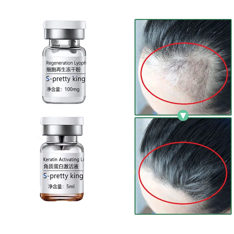Stem Cell Hair Growth Serum Sets 2 Pcs / Set Anti hair Loss Treatment  Stimulating Treatment Hair Care Essence for Men Women| | - AliExpress