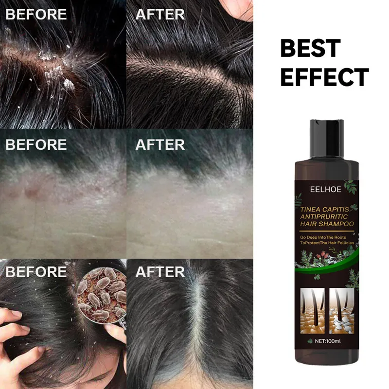 

100ml Therapeutic Shampoo Anti-Dandruff Treatment Itching and Flaking Scalp Psoriasis and Seborrheic Dermatitis Shampoo