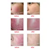 Facial Red Blood Streak Spot Blood Vessels Removal Beauty Machine High-Frequency Needle RF Spider Veins Removal Blood Vessels 6