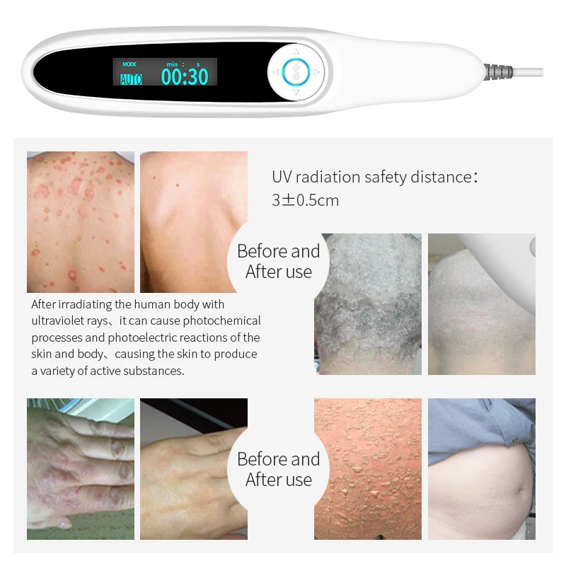 Vitiligo Therapy Device Psoriasis Skin Treatment Light 311nm Narrowband Ultraviolet Phototherapy Instrument UVB Lamp 5