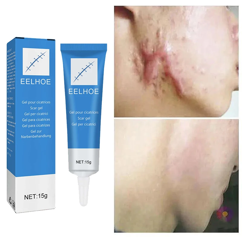 Laser Therapy Keloid Scar Repair Cream Reduces Hyperplasia Pregnancy Surgery Burn Scar Skin Repair