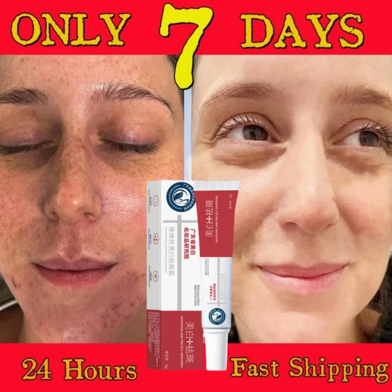 

Niacinamide Whitening Freckle Cream Removal Face Dark Spot Melasma Pigmentation Fade Melanin Improve Dullness Brighten Skin Care