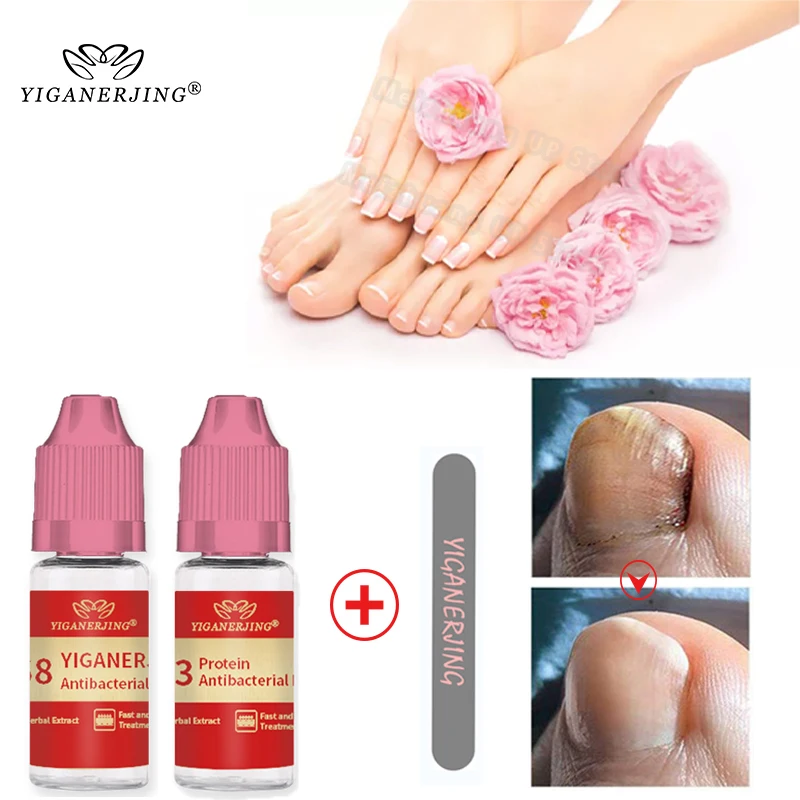 

YIGANERJING Fungal Nail Solution Treatment Onychomycosis Paronychia Repair Solution Toenail Growth Solution Nutrient Essence