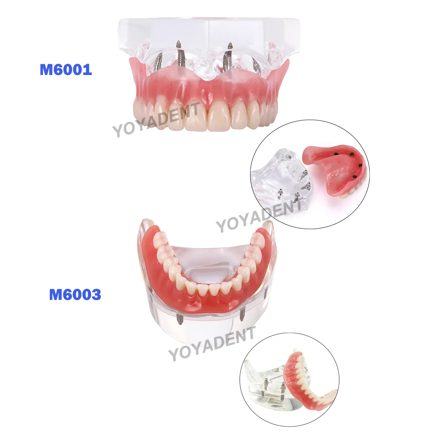치과 교정 치아 모델, 임플란트 모델, 제거 가능한 치주 질환, 병리 데모 송진 재료