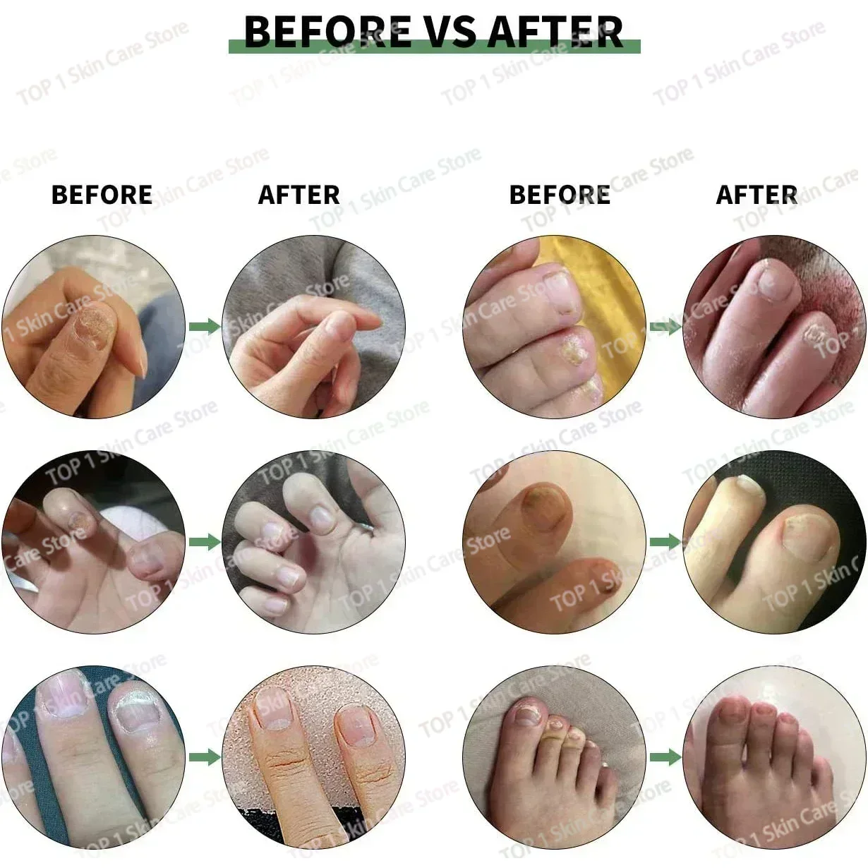 Fungal Nail Treatment Oil Foot Repair Essence Toe Nail Fungus Removal Gel Anti Infection Cream Fungal Removal