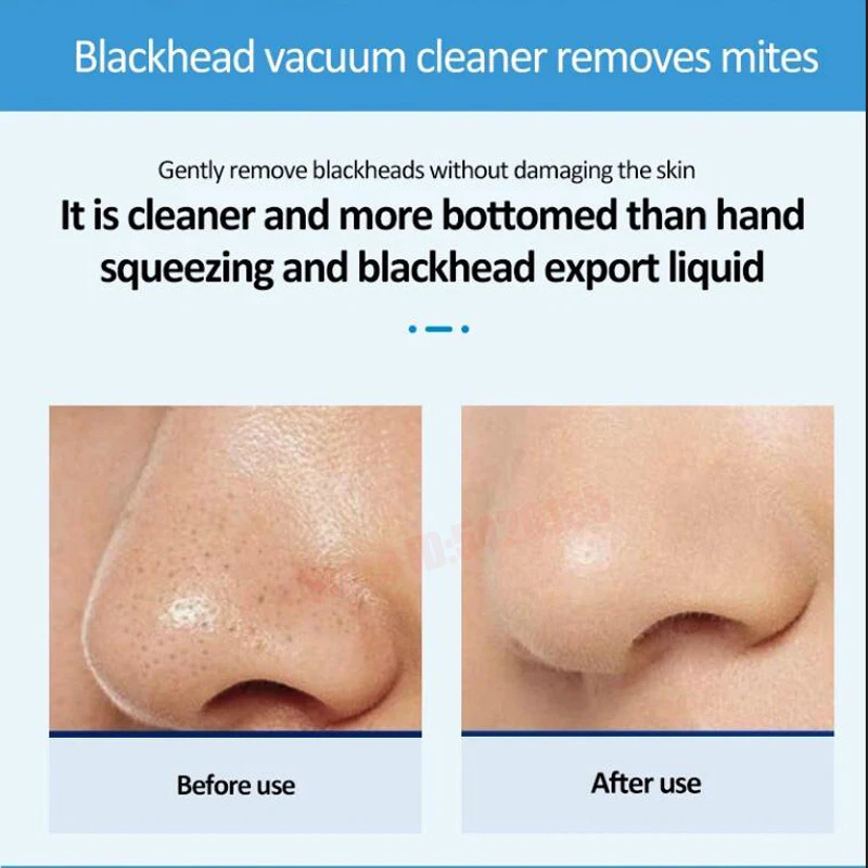 Nose Blackhead Peeling Solution Serum Facial Cleaning Liquid Scrub Special Solution Skin Deep Cleaning For Small Bubble 2