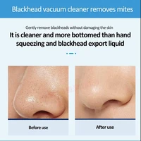 Nose Blackhead Peeling Solution Serum Facial Cleaning Liquid Scrub Special Solution Skin Deep Cleaning For Small Bubble 2
