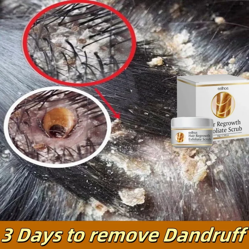 Scalp Treatment Fast Anti Exfoliating Scrub Remove Dandruff Anti Itching Seborrheic Scalp Oil Control Repair Scalp Beauty Health Care