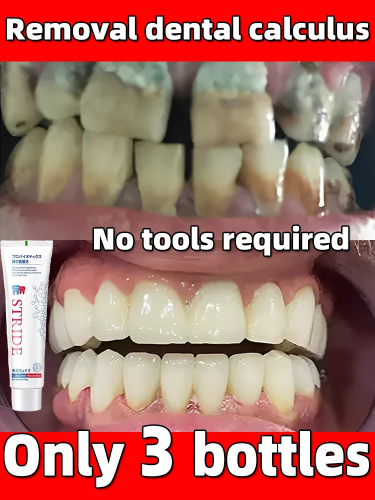 Dental Calculu Remover Toothpaste Whitening Teeth Mouth Odour Removal Bad Breath Preventing Periodontitis Repair Dental Plaque