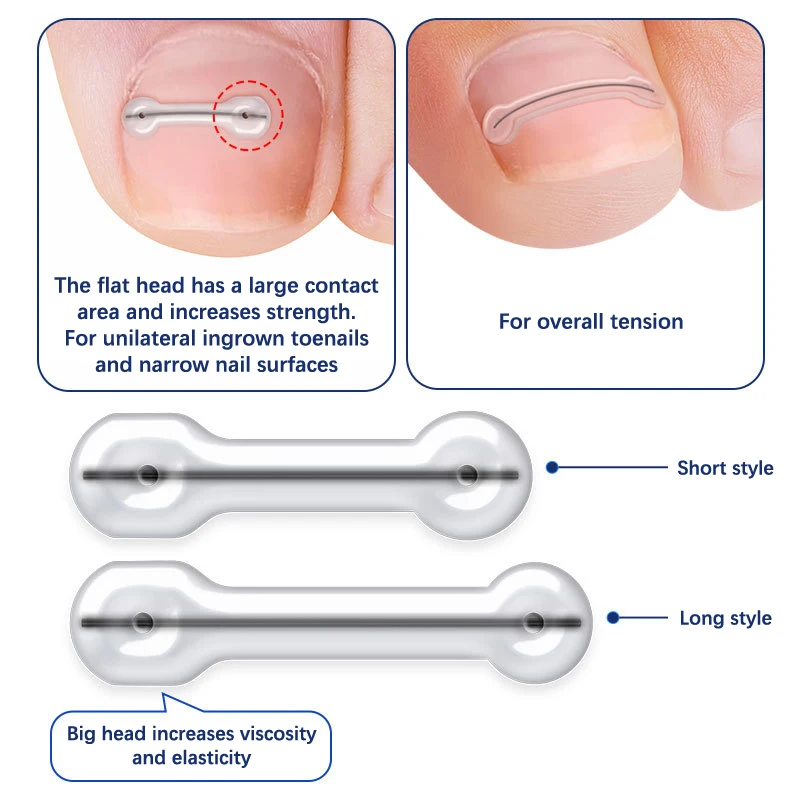 Ingrown Toenail Correction Tool Ingrown Toe Nail Treatment Elastic Patch Sticker Straightening Clip Brace Pedicure Tool 2Pcs