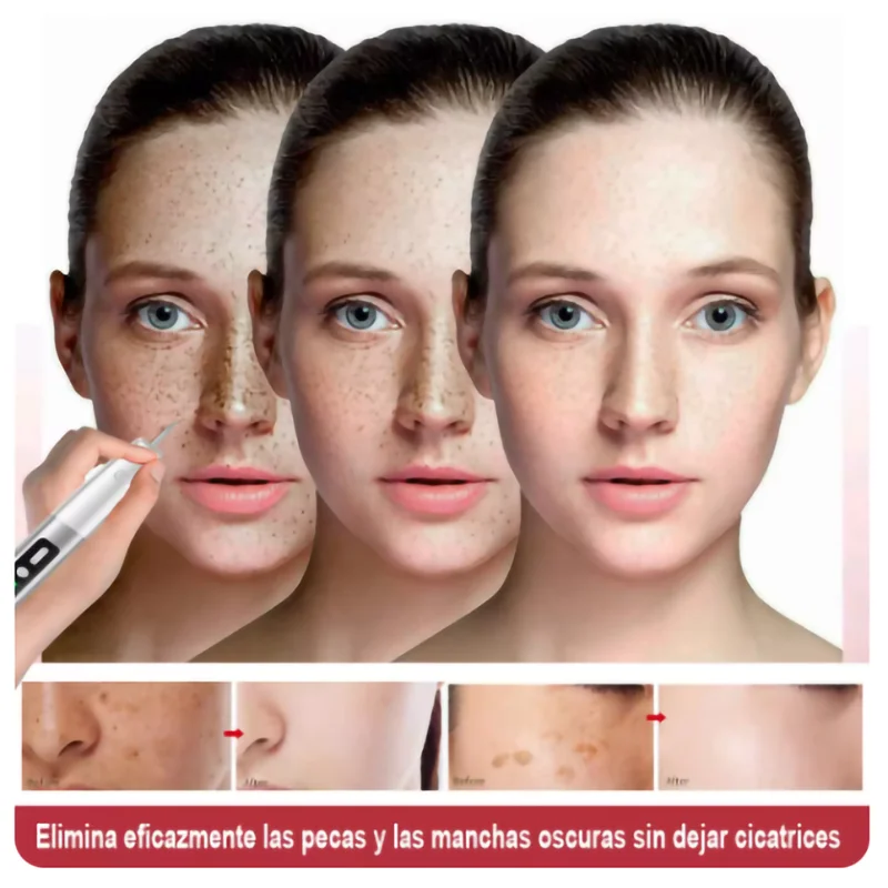 Plasma Pen Mole Blackhead Warts Dark Spot Black Acne Woman Dot Nevus Blemish Pimples Remover 15 Gears for Face Body Skin blackhead remover,skin tag removal tool,acne remover,facial pore cleanser,skin tag removal pen,laser skin treatment
