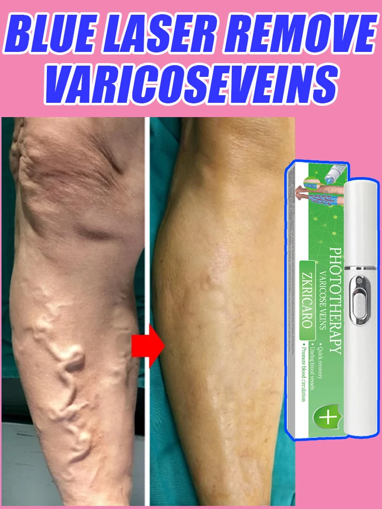 Varicose Vein Laser fractional co2 laser machine