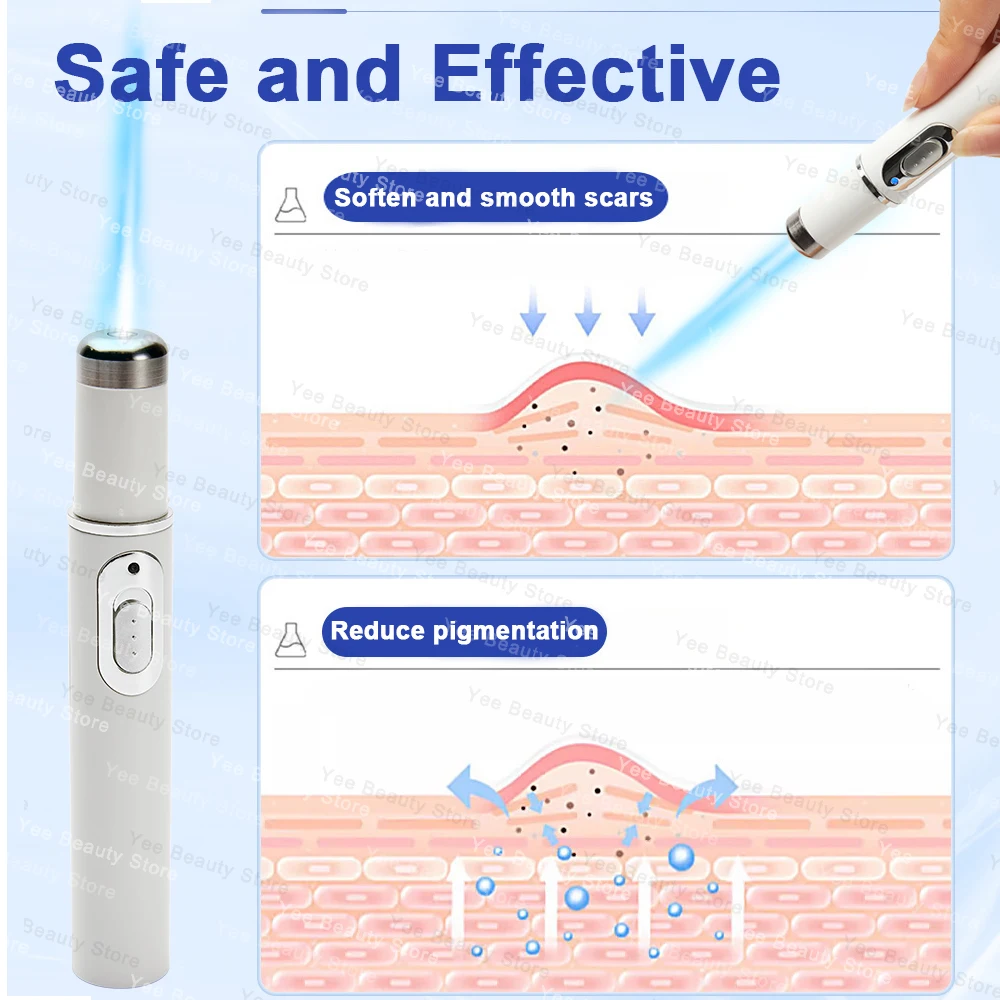 Laser Treatment Scar Cream Scar Relief Pen Laser therapy Keloid Scar Easy Harmless Comfortable Improve Keloid Pen Relief Products