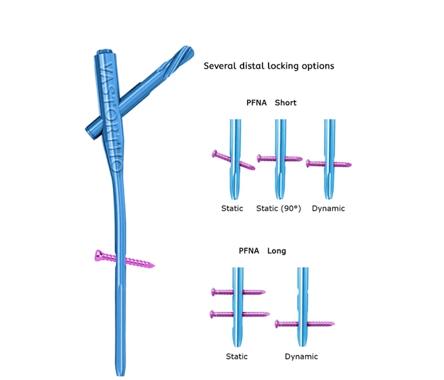 Subtrochanteric femoral fractures: a comparative study of the long proximal  femoral nail and the long trochanteric fixation nail | European Journal of  Orthopaedic Surgery & Traumatology