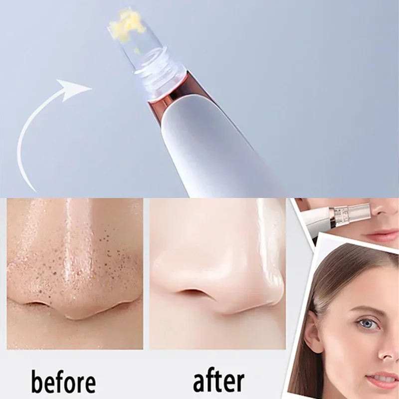 Blackhead Remover Acne Remover Facial Pore Cleanser Electric Blackhead Remover Vacuum Pore Cleaning Facial Black Spots White Dot Pimple Acne Cleaner Face Care Tool Beauty