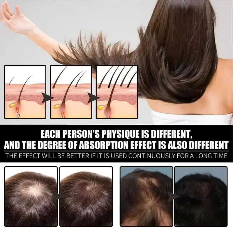 Hair Growth Serum 7 Days Fast Regrowth Essential Capsule Anti Hair loss Baldness Repair Damaged Scalp Treatment For Women Men