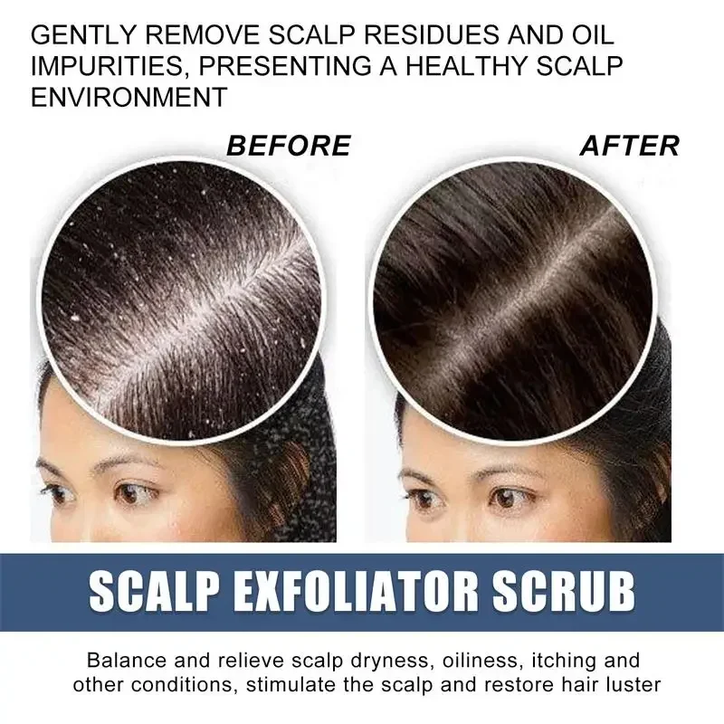 Fast Anti Exfoliating Scrub Remove Dandruff Anti Itching Treatment Seborrheic Scalp Oil Control Repair Scalp Beauty Health Care hair treatment scalp treatment