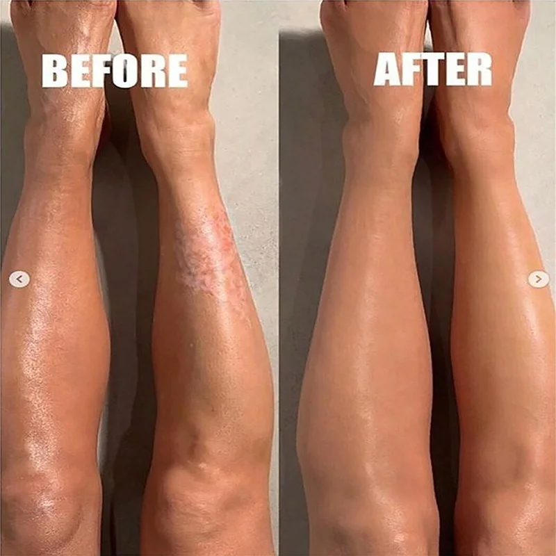 Natural Plant Extract Psoriasis Dermatitis Eczematoid Eczema Ointment Anti-Itch Chinese Herb Medical Skin Care Cream 15/30/50g