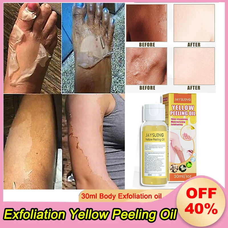 YellowPeelingOilBodyExfoliationBleachingDarkSkinRemoveArmKnee