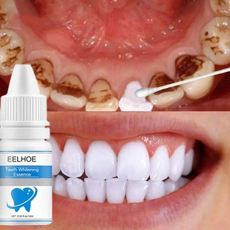 

Deep Cleaning Of Teeth Fast To Stains