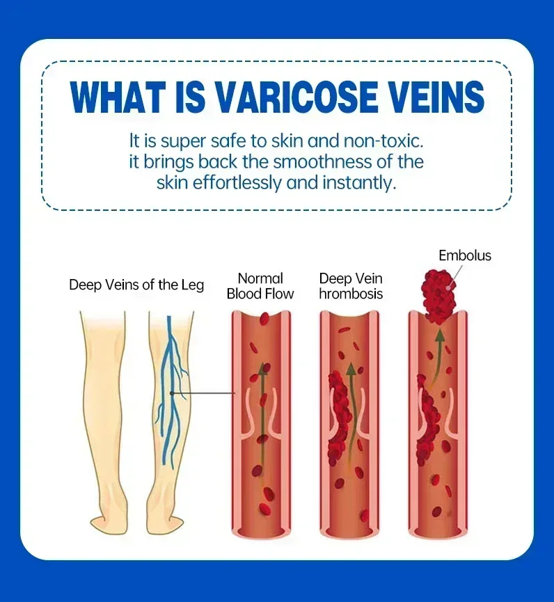 Effective Relief Varicose Vein Ointment Relieve Varicose Vein Vasculitis Spider Legs Pain Treatment Care Essential Cream varicose vein ointment