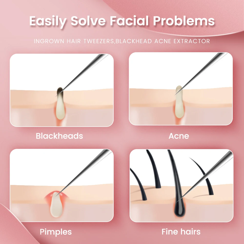 Blackhead Remove Strips German Ultra-fine No.5 Cell Pimples Blackhead Clip 0.1mm Blackhead Remover Tweezers Black Dots Pore Cleaner Acne Needle Tool