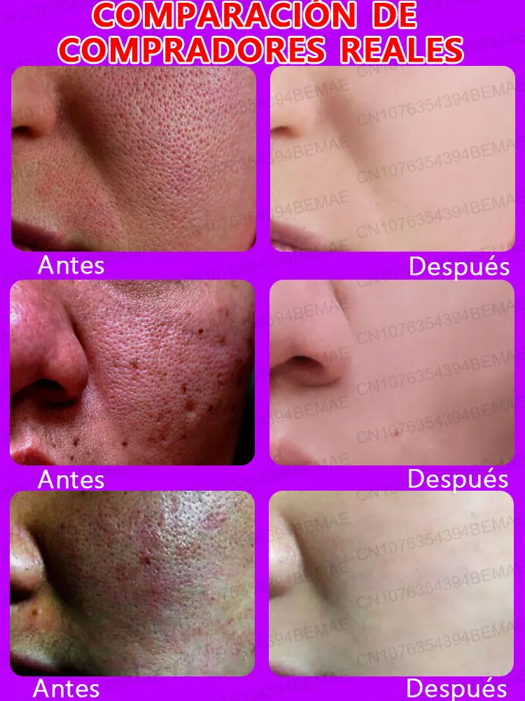 Pore shrinking serum for facial removal of large pores, firming and repair of large pores on face