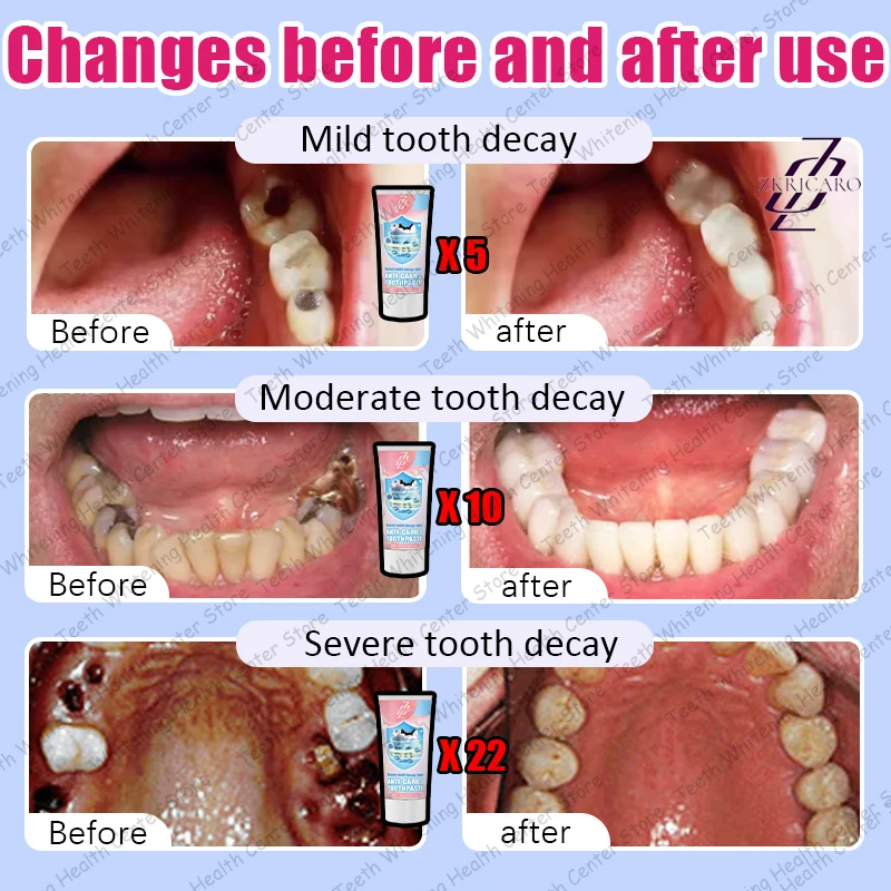 Tooth Decay Repair New Technology Efficient Repair of Tooth Decay