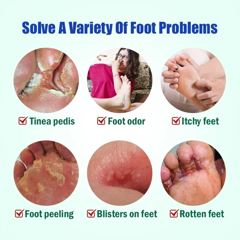 Anti Fungal Cream Herbal Cream 1pcs Foot Tinea Pedis Treatment Cream Treat Beriberi Ointment Anti-itch Inhibits Fungus Peeling Athlete Foot Medical Cream A942